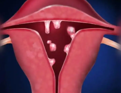 宫内膜息肉是什么病？影响试管成功率吗？