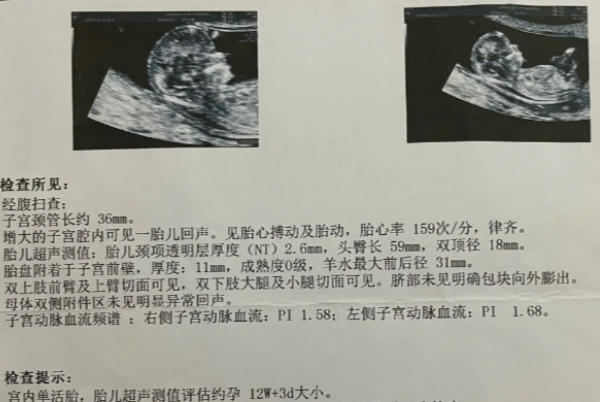 nt值无法判断胎儿性别