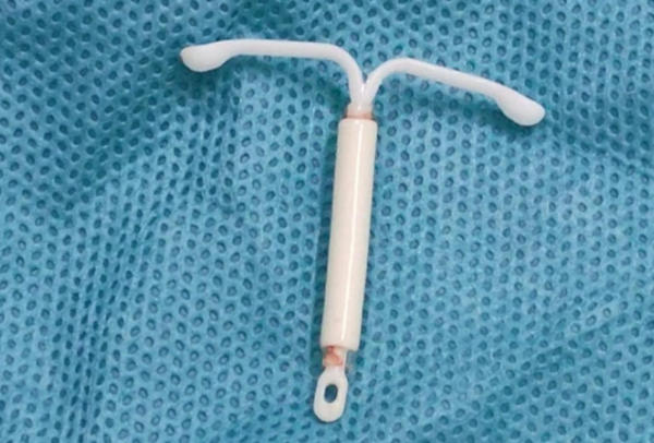 曼月环基于个体差异不取环