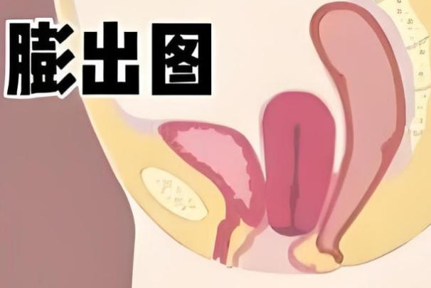 阴壁膨出程度会影响恢复时间