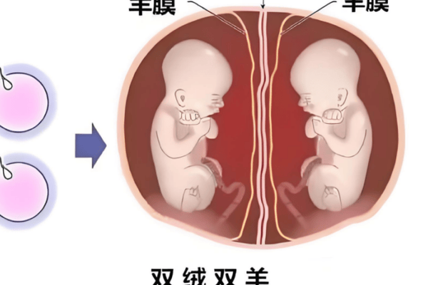 试管双胎和自然双胎产检有区别吗？风险分层PK常规随访