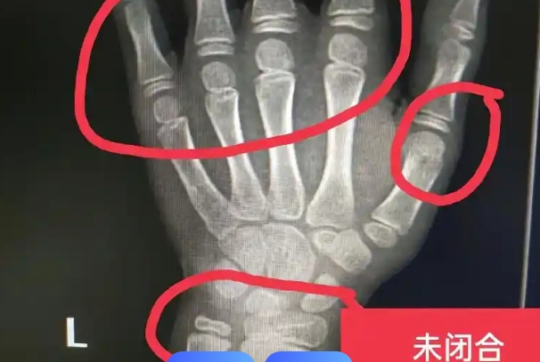 通过第二性征变化可以判断骨骼线状态