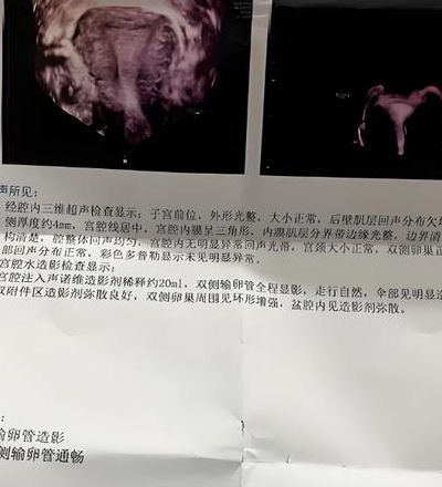 输卵管造影到底多疼？小红书两极评价让我腿抖着进检查室