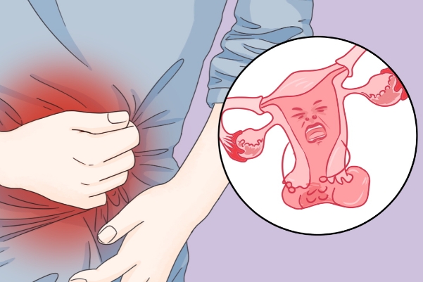 巧克力囊肿会影响<a href=