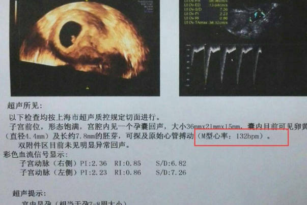 胎心像马蹄声是怀男孩