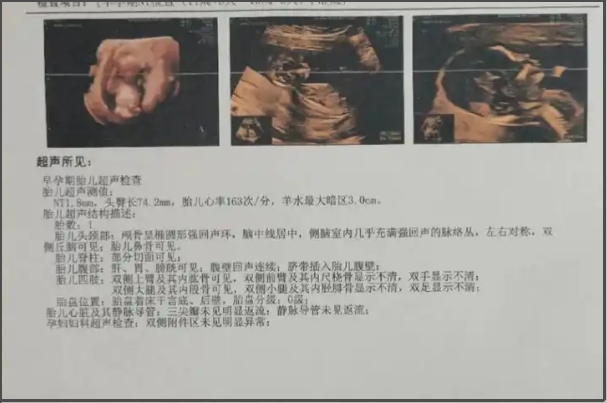 试管婴儿与自然怀孕相差不大