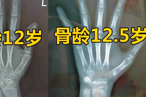 10到16岁宝宝骨龄对照表一览，13岁男孩年平均增长5厘米