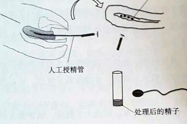 试管和人工授精是一回事吗？我做完才搞明白
