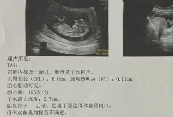 nt值无法判断胎儿性别