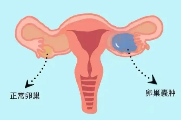 卵泡可能会被误诊为囊肿