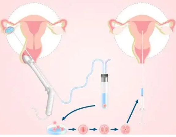 宫腔检查后多久可以移植试管