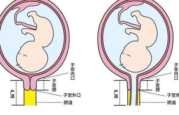 宫颈环扎术保胎成功率多少？关键看这三点和时机