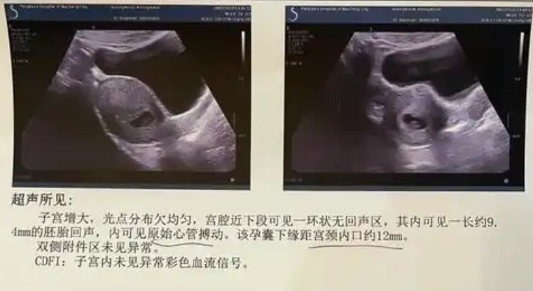 7周的孕囊无法判断性别