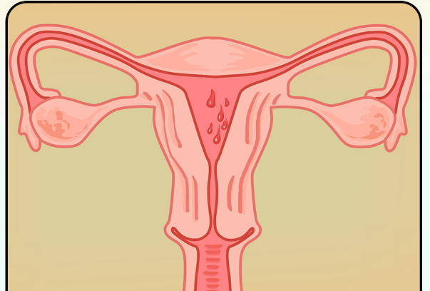 子宫内膜息肉拖久了会异常出现