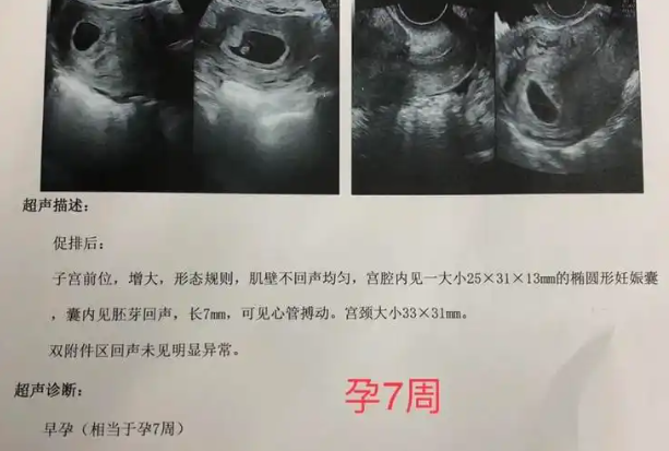 孕囊看男女不准确
