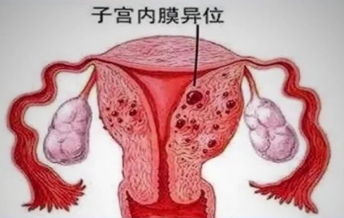 子宫内膜异位症4期是恶性 子宫内膜异位症4期是恶性