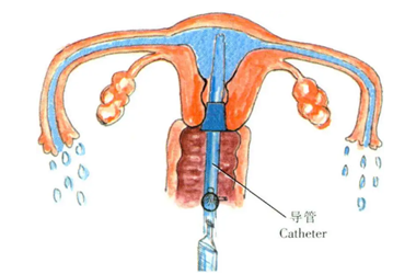 输卵管复通术有几种方案?输卵管服用书三种手术费用?