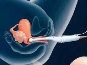子宫输卵管造影怎么做
