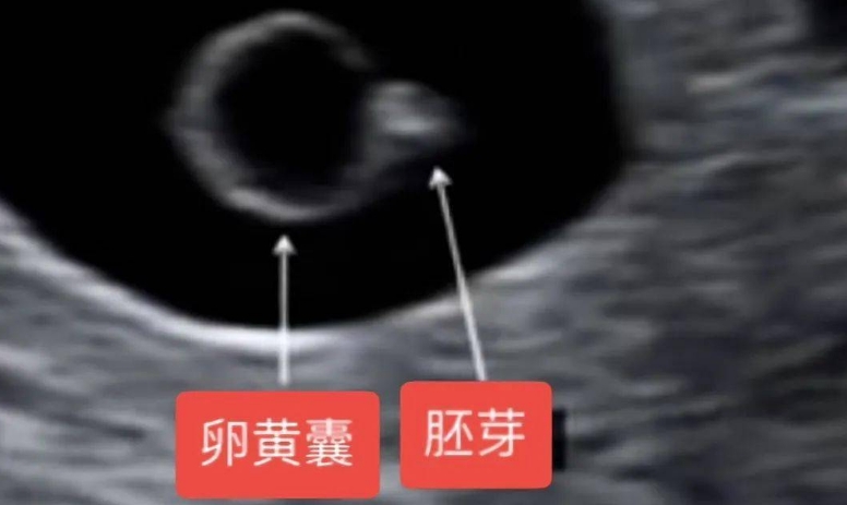 卵黄囊大小能预测胎儿性别