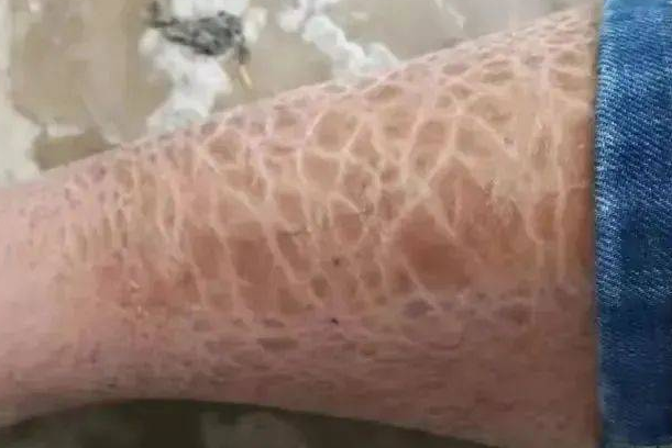 3代试管婴儿技术可以筛查有鱼鳞病的胚胎吗？