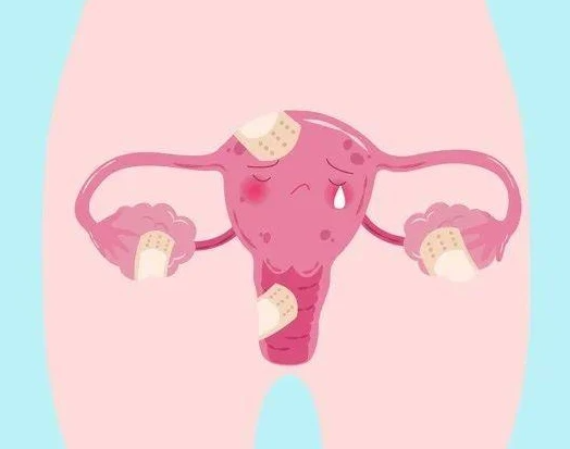 生殖专家科普女性得了子宫内膜异位症该如何备孕？