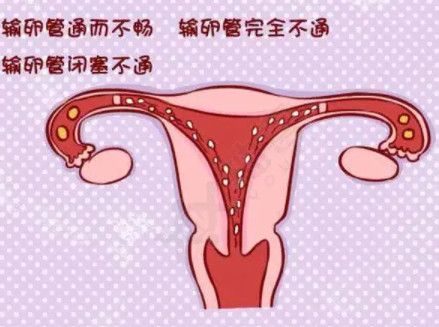 输卵管堵塞的症状怎么做试管