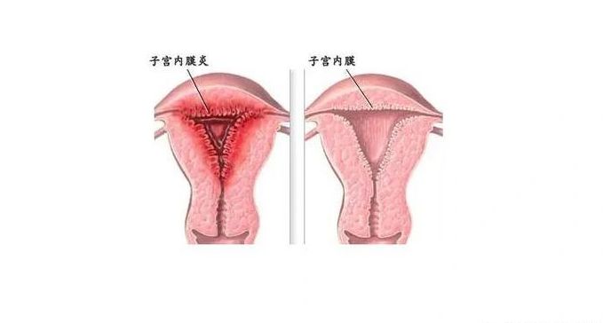 子宫内膜炎影响试管吗女性，先看这4个判断维度