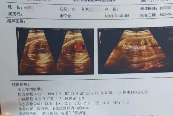 技术的局限性会导致小排畸容易出问题