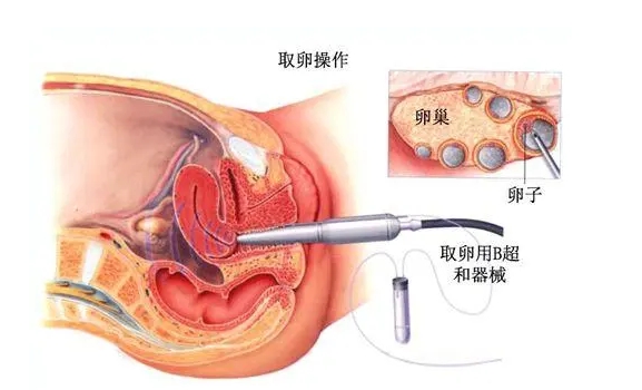 去泰国做试管婴儿需要多长时间