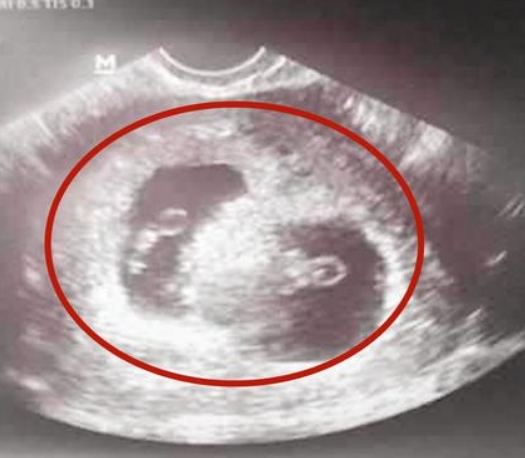 双胎发育和母体有关