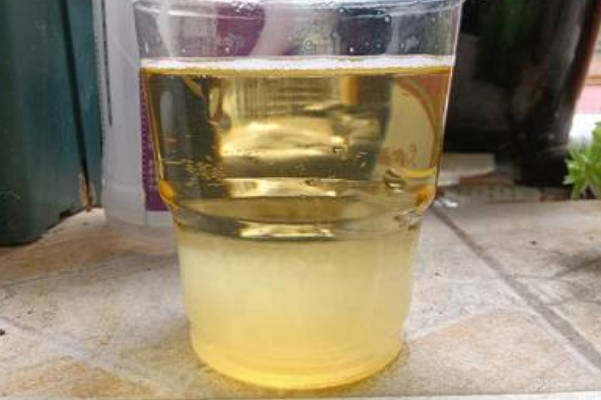 请问有没有用75%酒精加晨尿测男女的分层图呢？