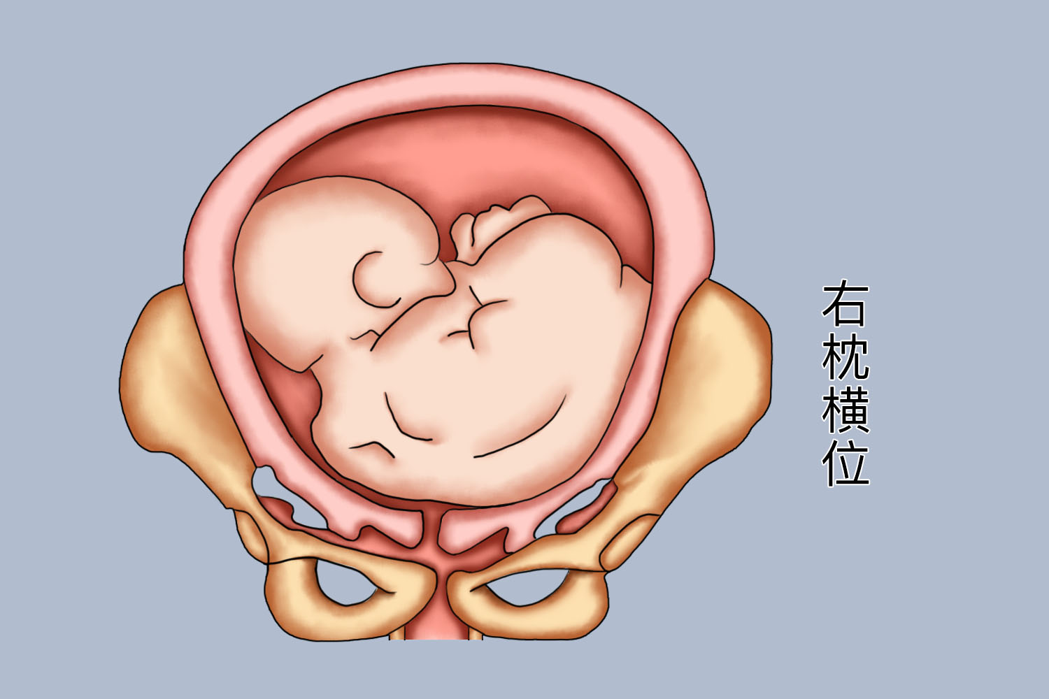 胎儿右枕横位图片示意图 
