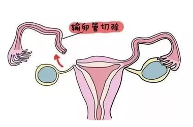 还剩一侧输卵管试管也会宫外孕的可能性?