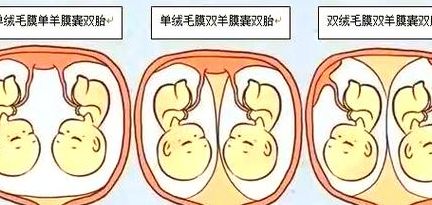 试管男女双胎长大后的弊端是什么？三个现实问题提前想清楚