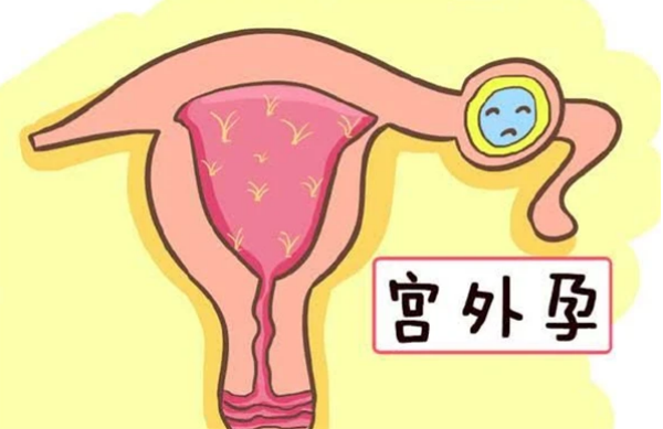 囊胚移植宫外孕的几率