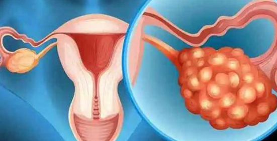 卵泡20个以上可能是多囊