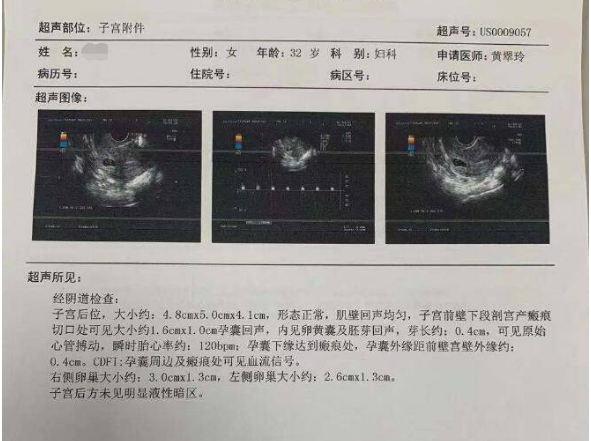孕囊看男女准确率不高