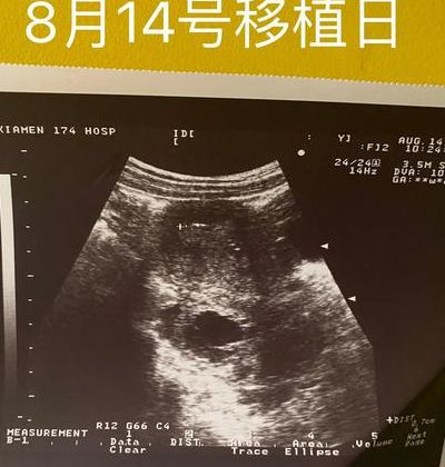 取完卵后多久移植优质成功？不是固定天数，关键看这三点