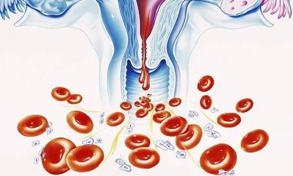 移植囊胚大量出鲜血是着床还是失败?