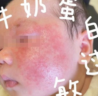 奶粉过敏都有哪些症状？皮肤和肠胃会先发出这3个信号