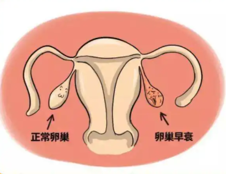 女性卵巢早衰做试管还能成功吗？