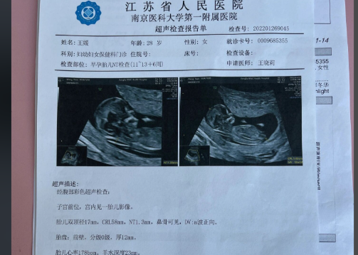 nt是检查胎儿是否有畸形的
