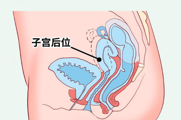 子宫后位可能会导致痛经加剧