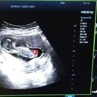 做完NT检查后，可以告诉别人怀孕了吗?