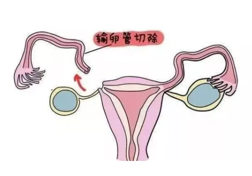 输卵管切了两边还能怀孕吗，试管怀孕几率有多少？
