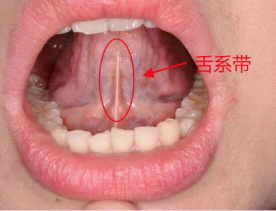 剪孩子舌系带可能影响进食