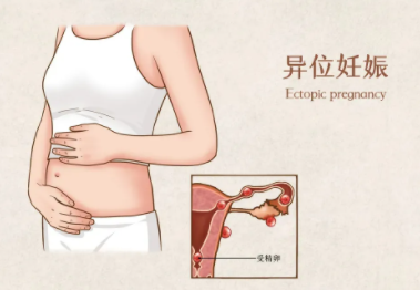 试管婴儿宫外孕征兆