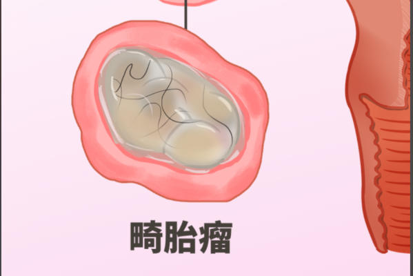 畸胎瘤与胚胎发育无关