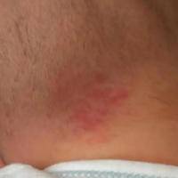 有鹤吻痕的宝宝是来报恩的?其实只是一种生理正常现象