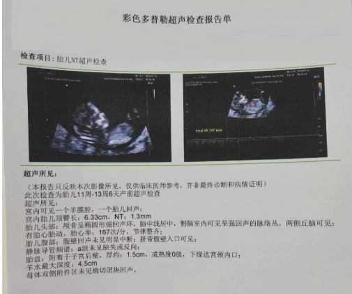 nt检查可判断胎儿是否发育正常
